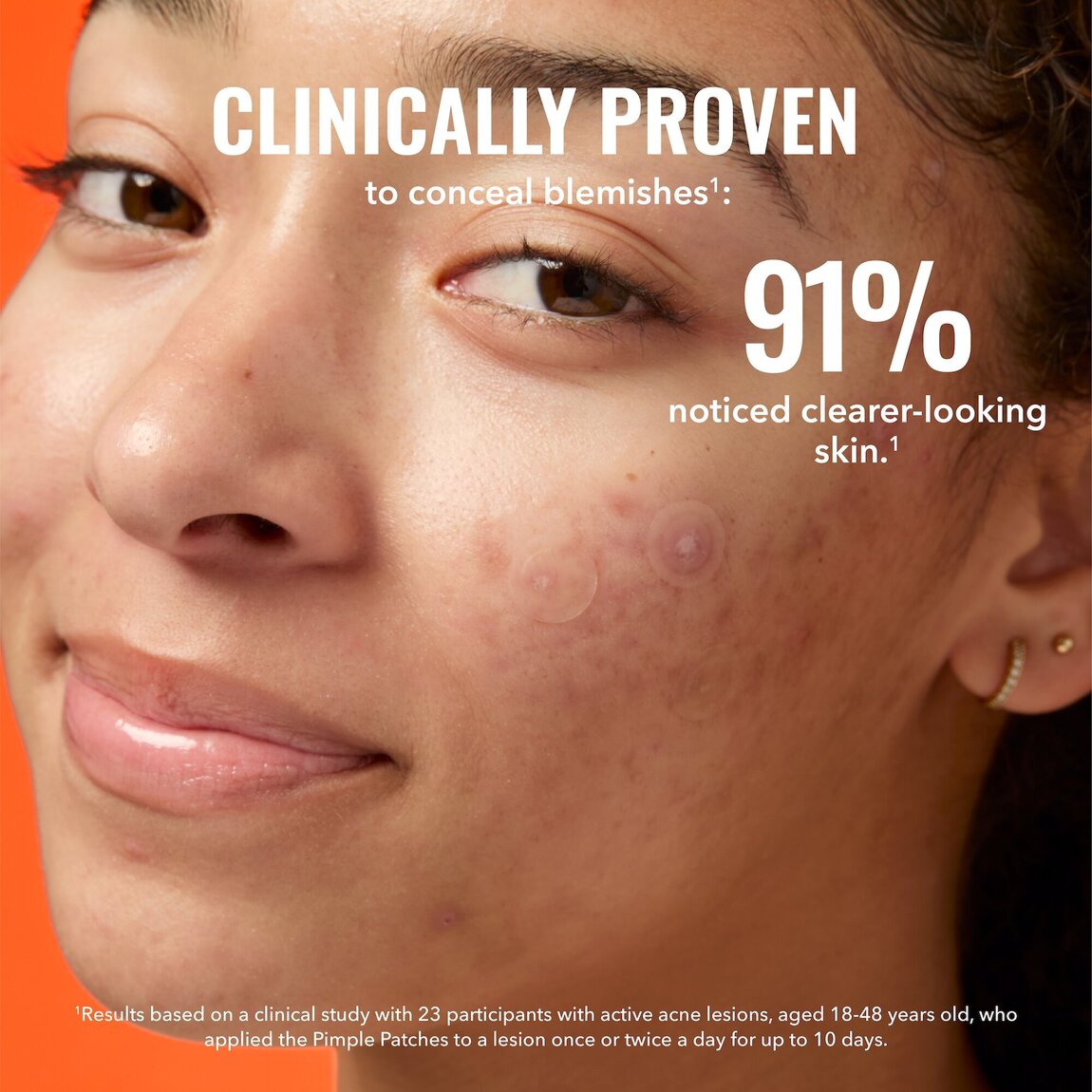 pimple-patches-n6 zb_p.jpg