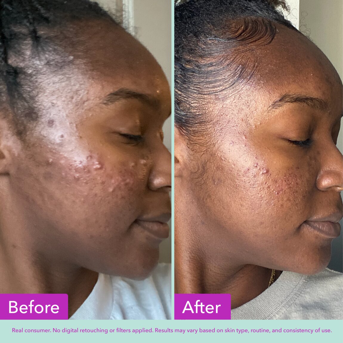 acne-foaming-cleanser-d6 zb_p.jpg